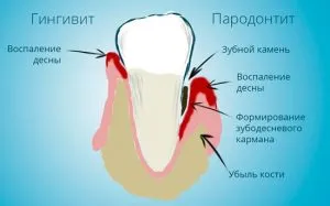 як лікувати кровоточивість ясен в домашніх умовах
