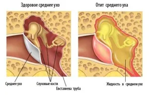як лікувати постійний отит