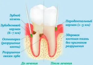 як лікувати кровоточивість ясен в домашніх умовах