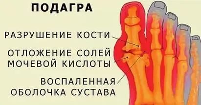 Подагра, вплив нирок на дану хворобу причини захворювання як лікувати нирки при подагрі