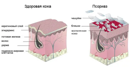 як лікувати запущений псоріаз