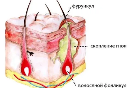 як лікувати прищі на члені