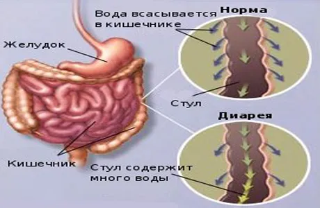 як лікувати діарею під час вагітності