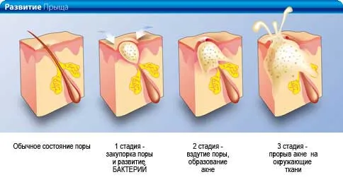як лікувати прищі між сідницями
