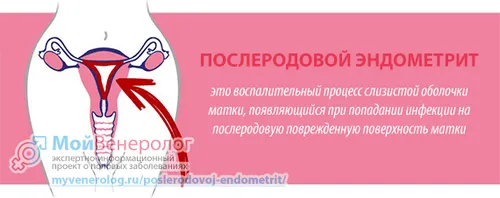 як лікувати післяпологовий ендометрит