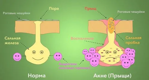 як лікувати прищі між сідницями