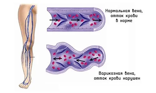як вилікувати ноги від болячок