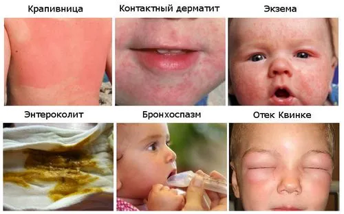 як лікувати алергію грудничку