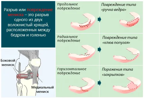 як лікувати забій меніска