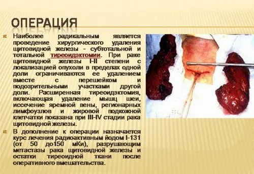 папілярний рак