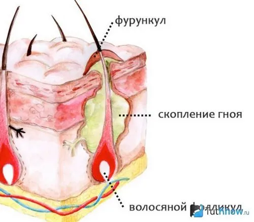 фурункули