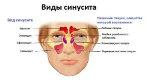 як довго лікувати синусит