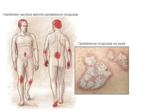як лікувати псоріаз на руках і ногах