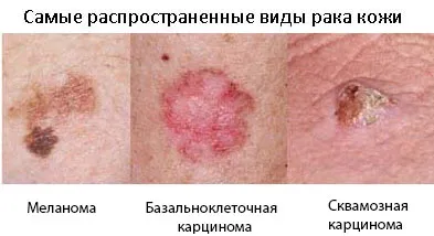 Рак шкіри обличчя: симптоми, причини виникнення, методи лікування, фото фото