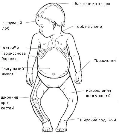 Рахіт у дітей як лікувати рахіт у 3 місяці