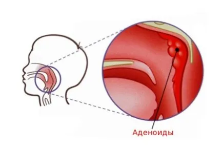 аденоїди (10) ключі