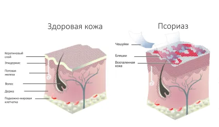 як швидко лікувати псоріаз на обличчі