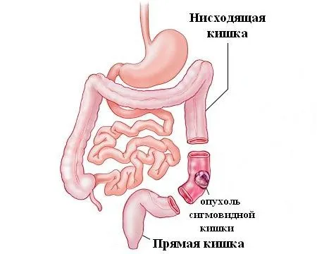 рак сигмовиднакишка причини симптоми стадії діагностика лікування ознаки пухлина кишечник