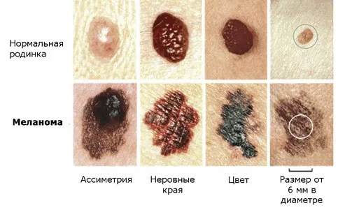 Рак шкіри обличчя: симптоми, причини виникнення, методи лікування, фото лікування