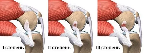 як лікувати частковий розрив зв'язок коліна