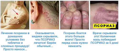 як лікувати псоріаз на обличчі