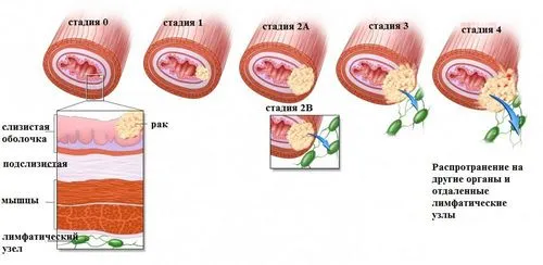 як лікувати рак щоки