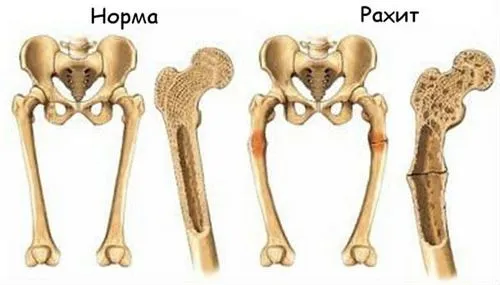 Рахіт у дітей: сутність та причини, симптоми і терапія як лікувати наслідки рахіту