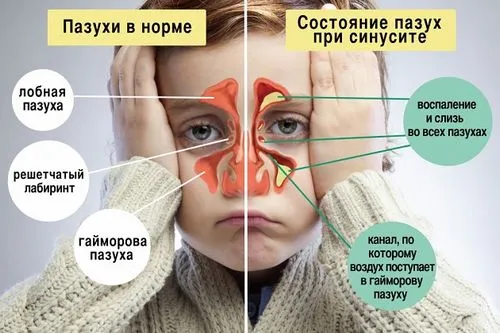 хронічний гайморит мирамистин