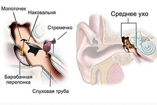 серозний отит