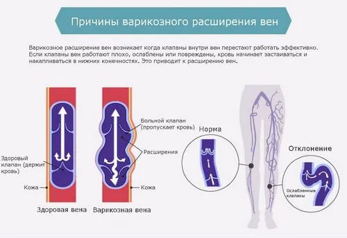 як лікувати внутрішній варикоз