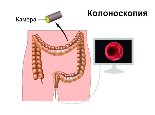 як вилікувати рак товстої кишки