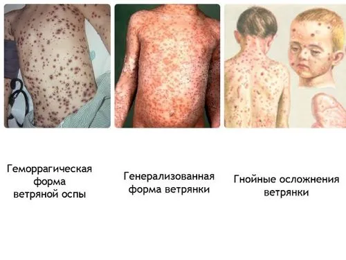 як лікувати вітрянку у дорослої людини
