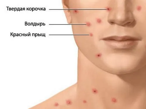 як лікувати вітрянку у дорослої людини