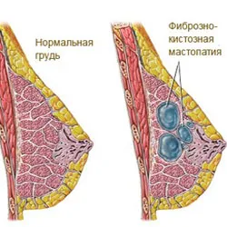 як лікувати мастопатію чистотілом