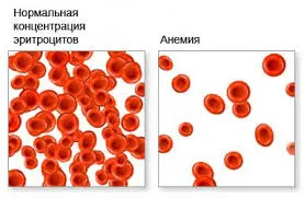 Ступеня анемії по гемоглобіну як лікувати анемію легкого ступеня
