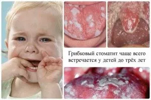 лікувати стоматит дітям