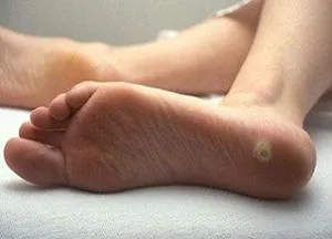сухі мозолі на ногах