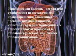 як лікувати тромбоз кишечника