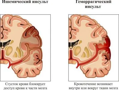як довго лікувати інсульт