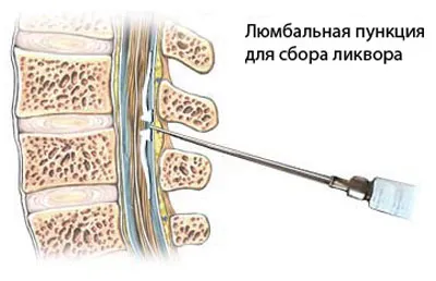 як лікувати прихований сифіліс