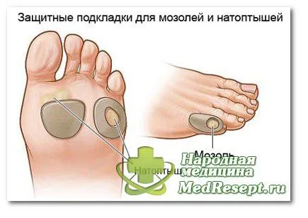 Сухі мозолі на ногах сухі мозолі на ногах