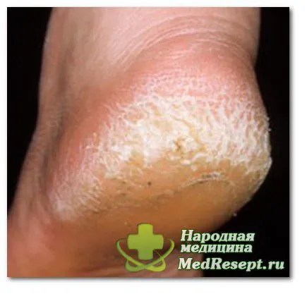 Сухі мозолі на ногах сухі мозолі на ногах