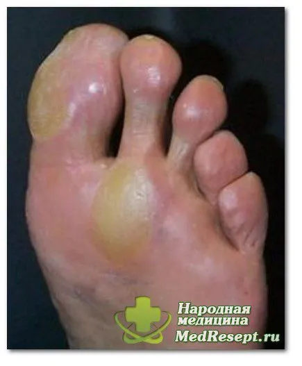 Сухі мозолі на ногах суха мозоль лікування