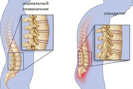 Туберкульоз кісток і суглобів: симптоми туберкульоз кісток суглоби симптоми
