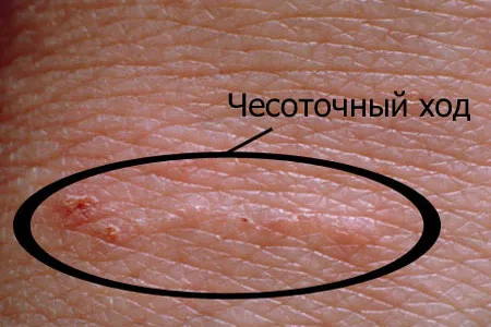 як лікувати алергію на тілі