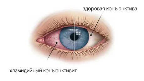 хламідіоз у дитини симптоми