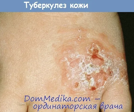 туберкульоз шкіри