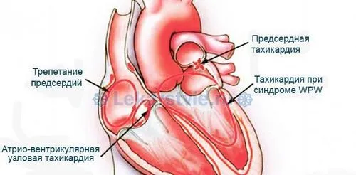 як лікують пароксизмальную тахікардію