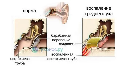 як лікувати тубоотит