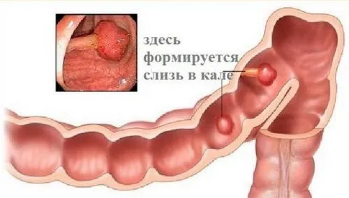 як лікувати виділення з заднього проходу